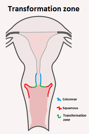 Cervical Cancer and CIN - almostadoctor